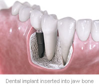 Dental implant inserted into jaw bone